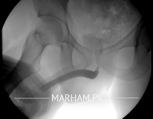 Retrograde Urethrogram
