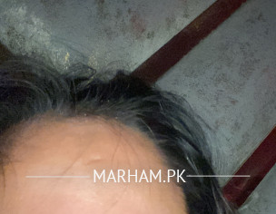 Discolouration Face