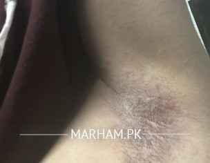Under Arm Rash 