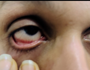 Eye Irritation
