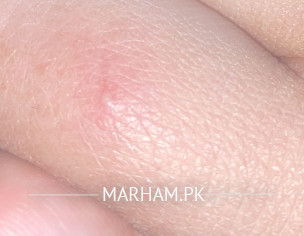 Skin Issue