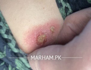 Skin Issue