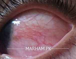 Eye Problem
