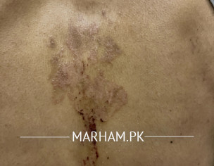 Skin Issue