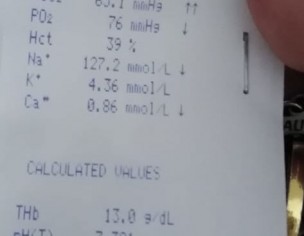 Difficulty In Breathing, When Walk Oxygen Level Decrease To 60%