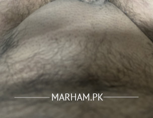 Pubic Area Swellig