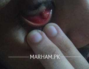 Eye Problem