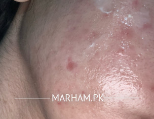 Acne, Acne Scars
