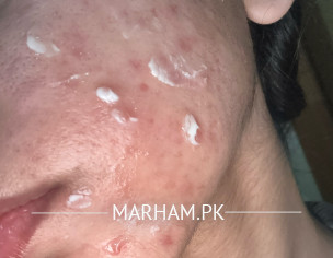 Acne, Acne Scars