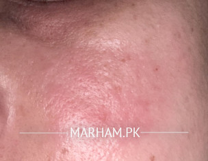 Face Redness 
