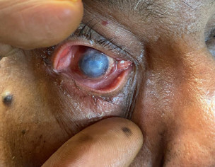 Cornea Transplant
