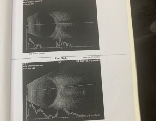 Cornea Transplant