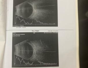 Cornea Transplant