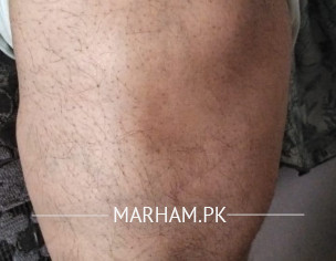 Knee Swelling 
