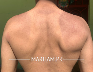 Marks On Back By Sunlight Exposure
