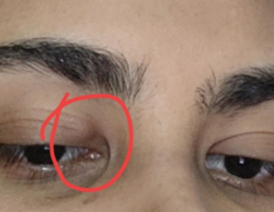 Eye Problem
