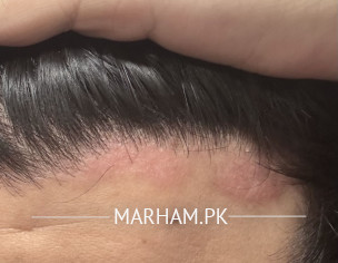 Psoriasis 
