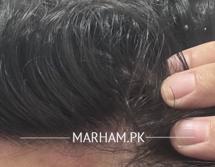 Psoriasis 