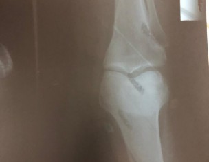 Knee Pain 