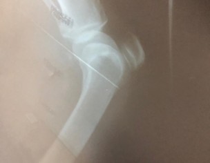 Knee Pain 