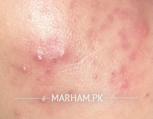 Acne And Recurrent Pimples