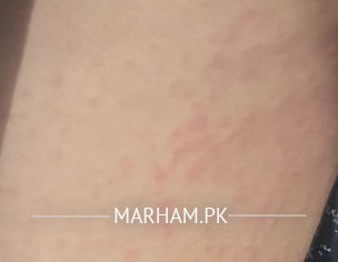 Red Bumps/rash