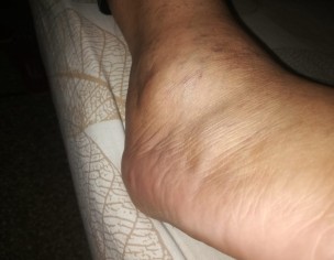 Swelling On Foot