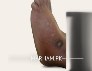 Sprains - پاؤں کی موچ