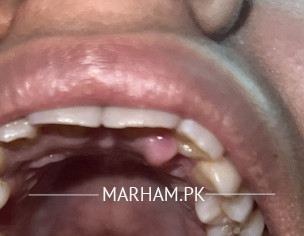 Painless Bump Underneath Gum