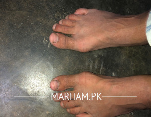 Foot Bone Growing Sideways 