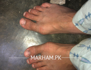 Foot Bone Growing Sideways 
