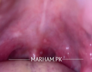 Mouth Bump