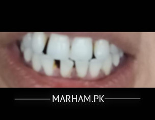 Space In Teeth
