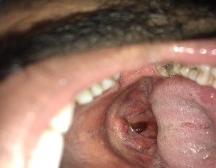 Red Color Sputum 