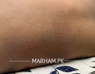 Skin Issue