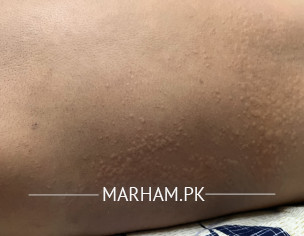 Skin Issue