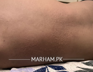 Skin Issue