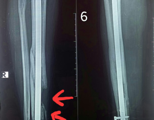 Tibia Bone Gap