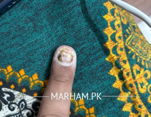 Finger Nail Deformed 