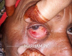 Eye Problems