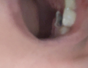 Teeth Problem