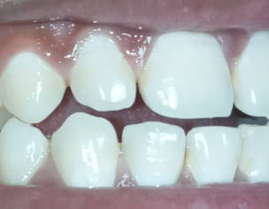 Small Gap Between My Front Teeth Also Lower