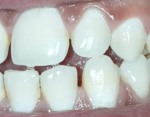 Small Gap Between My Front Teeth Also Lower