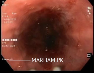 Reflux Esophagitis