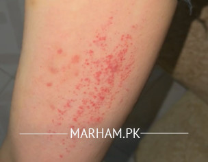 Bad Allergy 