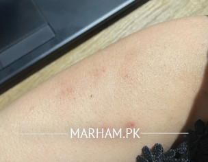 Skin Allergy And Itching