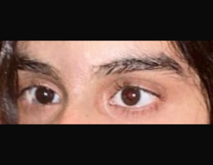 Squint Eye