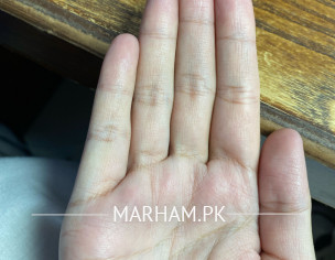 Hand Sweating 