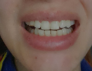 Teeth Braces