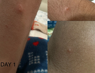 Blisters On Arms